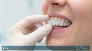 Removable Veneers: Price, Benefits & Drawbacks