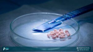 Sapphire FUE Hair Transplant: Everything you want to know