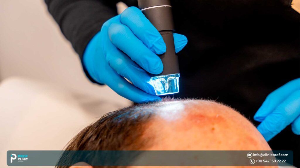 Sapphire FUE hair transplant procedure