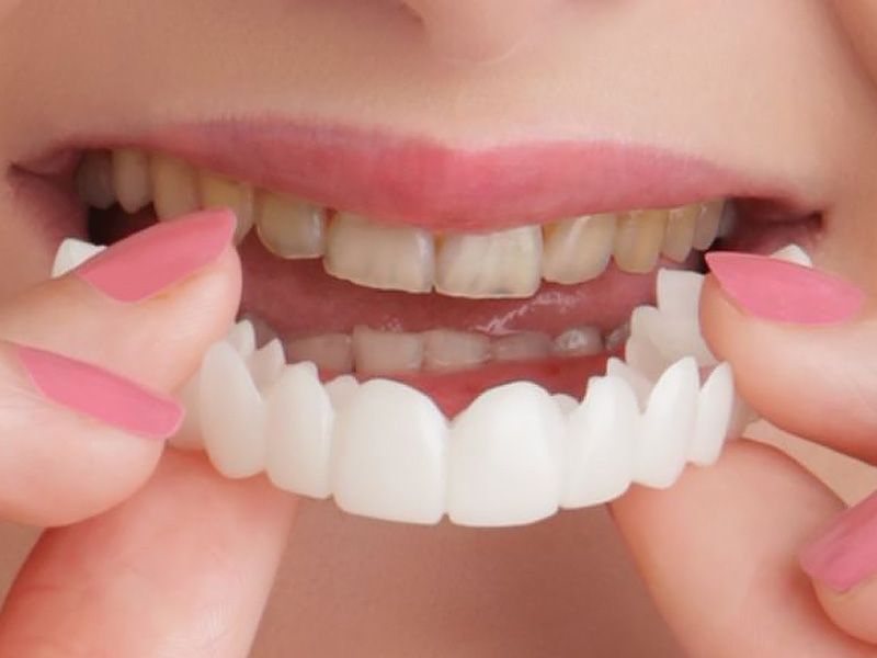 Snap-On Smile: All You Need to Know