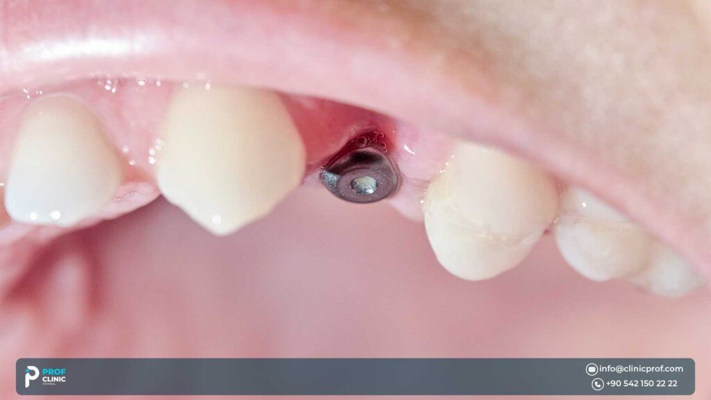 Steps to Zirconia Implant Crown