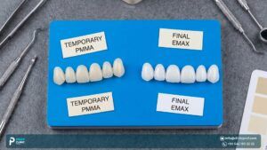 Temporary Veneers in Turkey: What to Know Before Getting Started