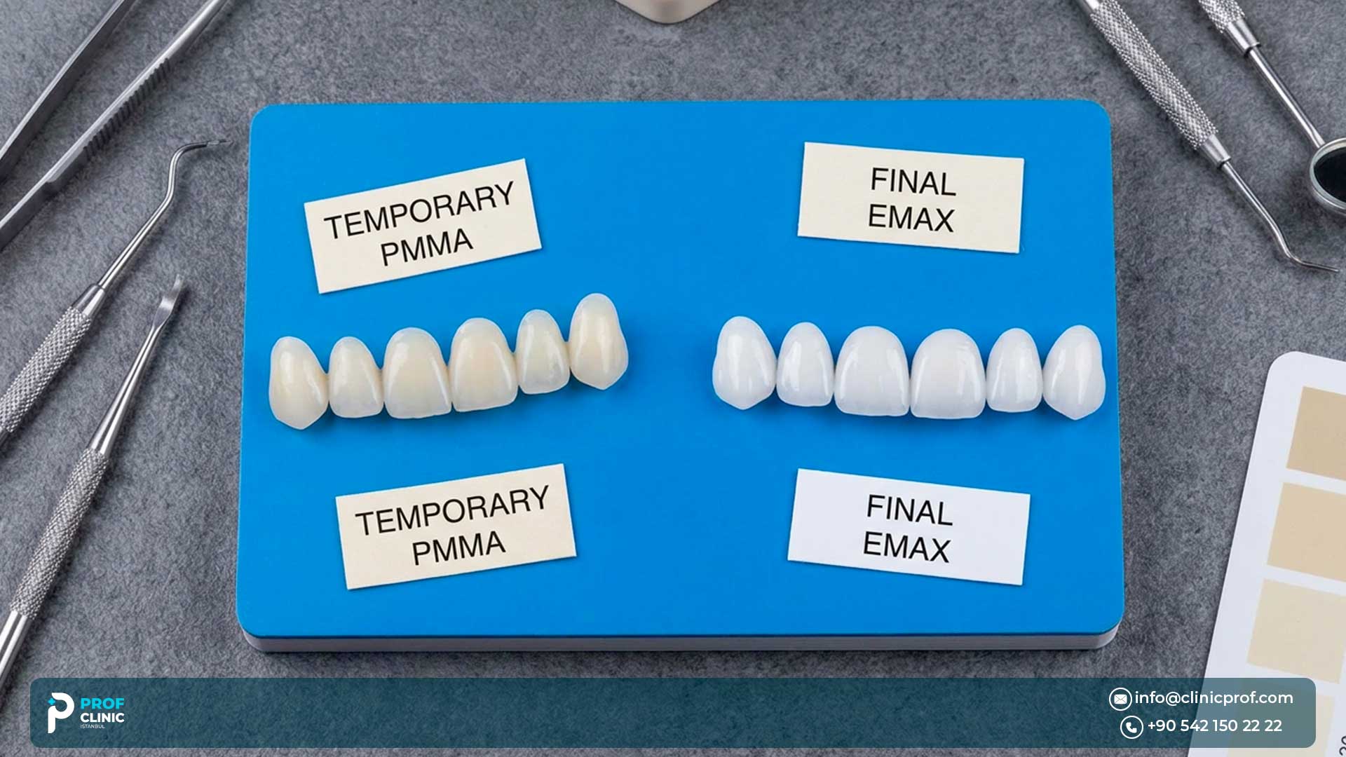 Temporary Veneers in Turkey: What to Know Before Getting Started