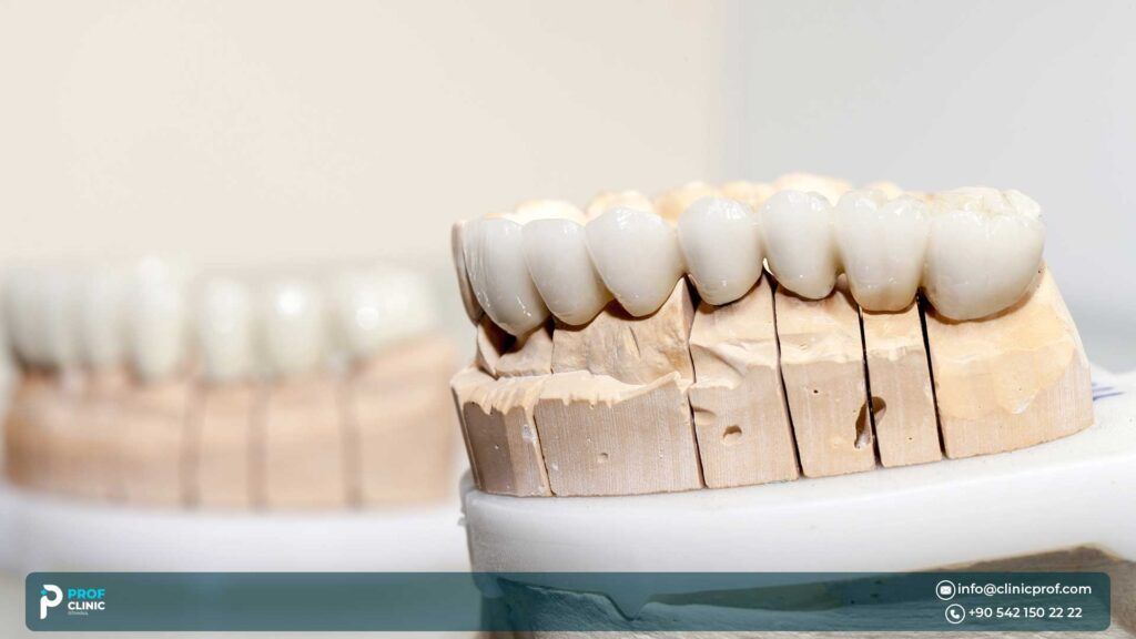 The Cosmetic and Functional Benefits of Veneers in Turkey