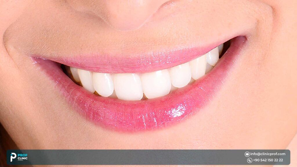 The Pros of Getting a Hollywood Smile in Turkey