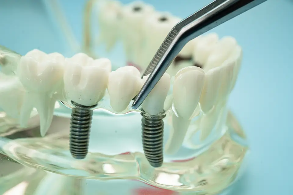 Titanium Dental Implants: Cost, Pros & Cons