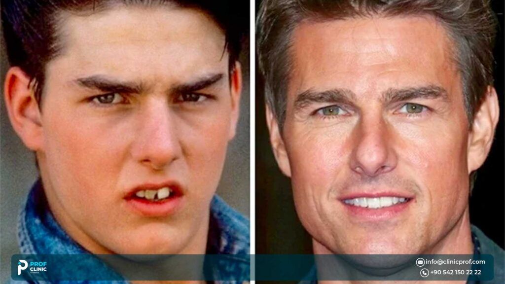 Tom Cruise’s Teeth: Before and After