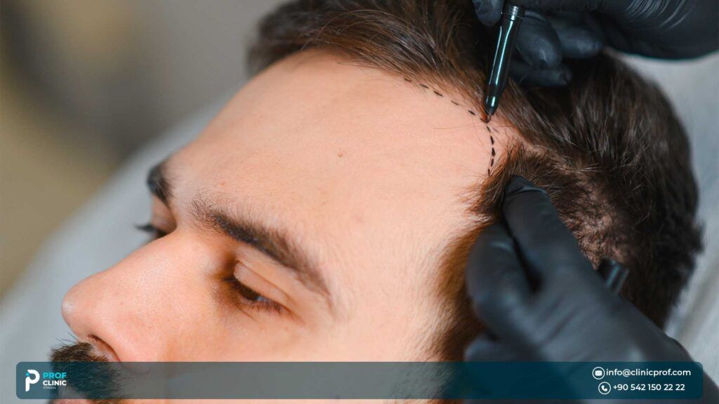 Turkey Hair Transplant Cost in 2025: What You Need to Know