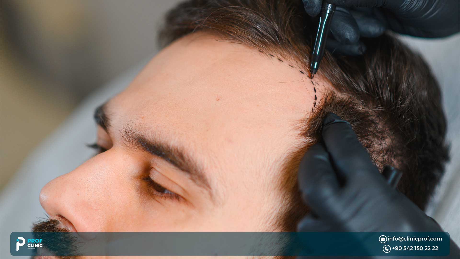 Turkey Hair Transplant Cost in 2025: What You Need to Know