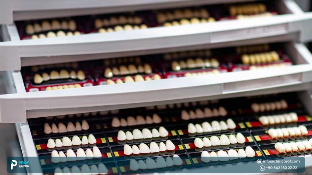 Types of Dental Veneers