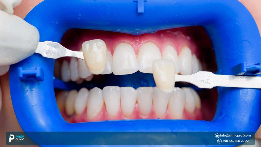 Veneers Cost In Turkey : Achieve Your Dream Smile with Affordable Dental Veneers