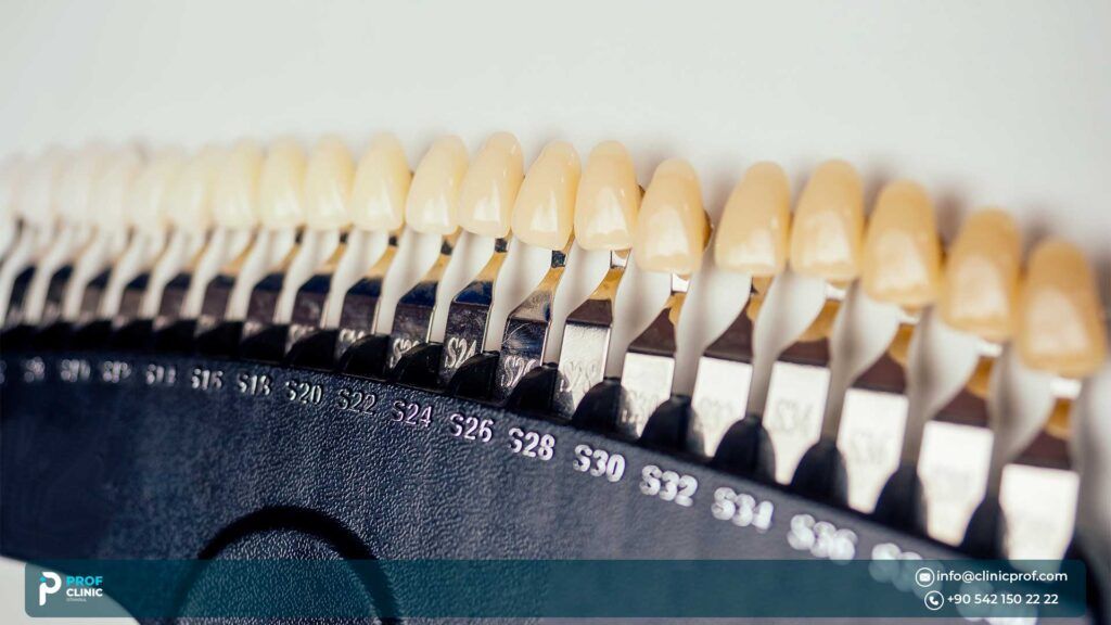 Veneers Without Shaving Teeth
