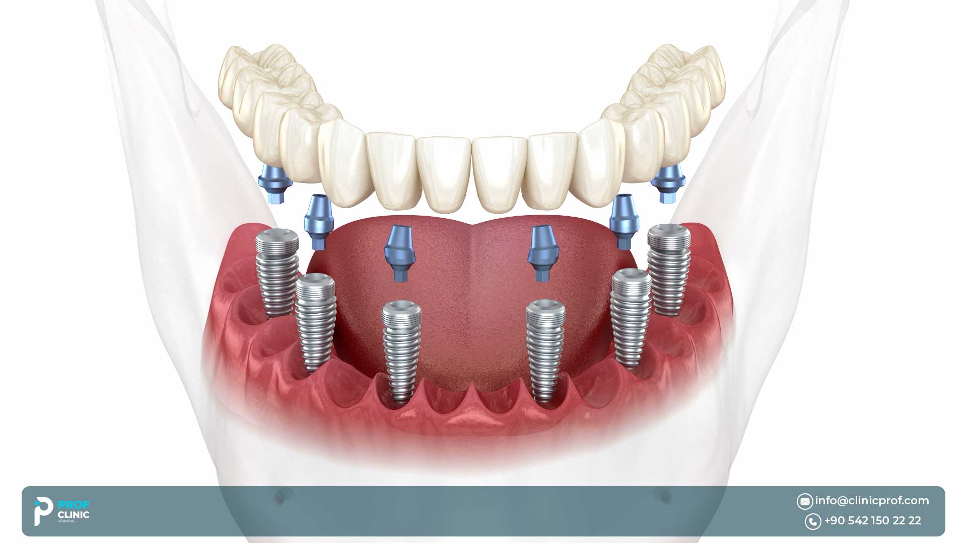 What Are All on 6 Dental Implants?