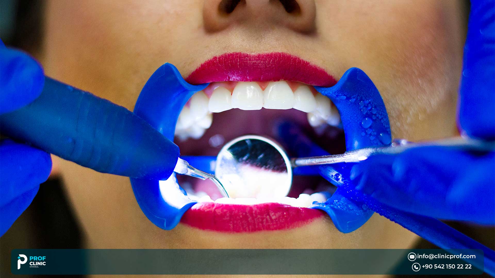 What Are Composite Veneers?