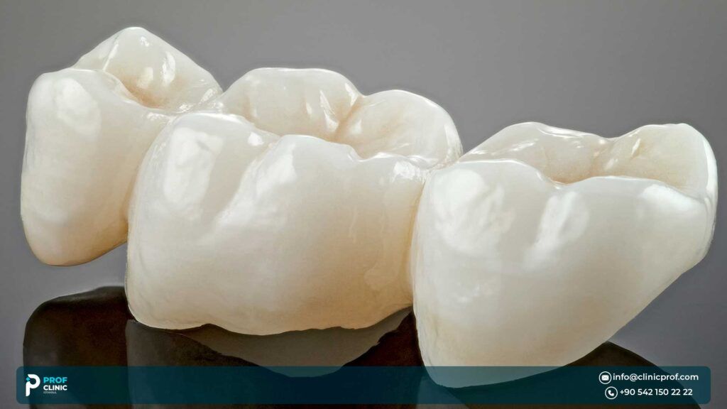 What Are Emax Crowns?