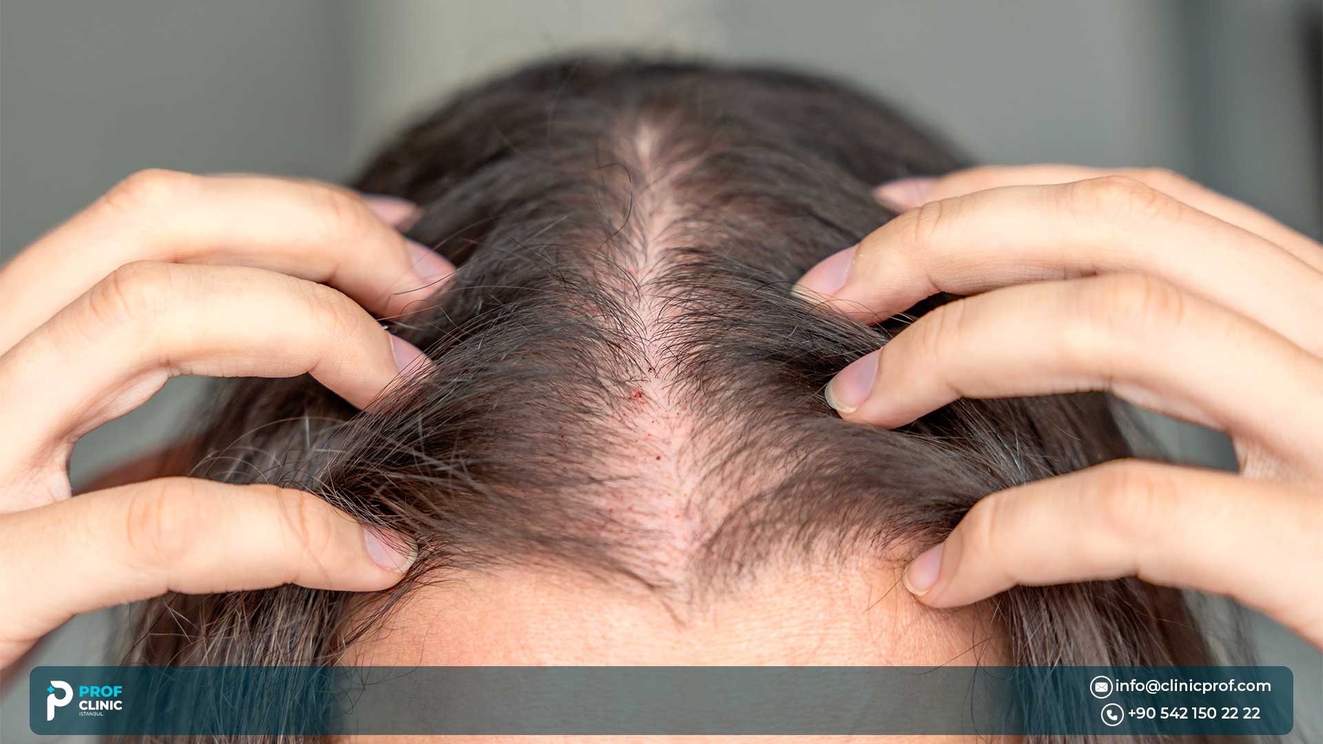 What Are Hair Implants for Women?