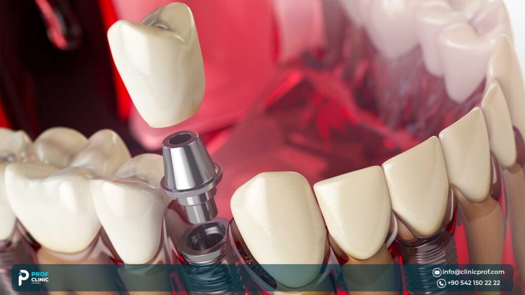 What Are Mini Dental Implants?