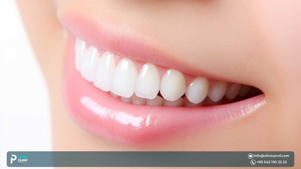  What Are Porcelain Veneers?