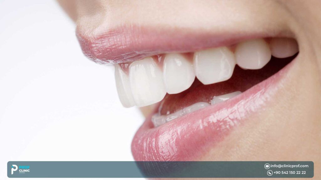 What Are Veneers?