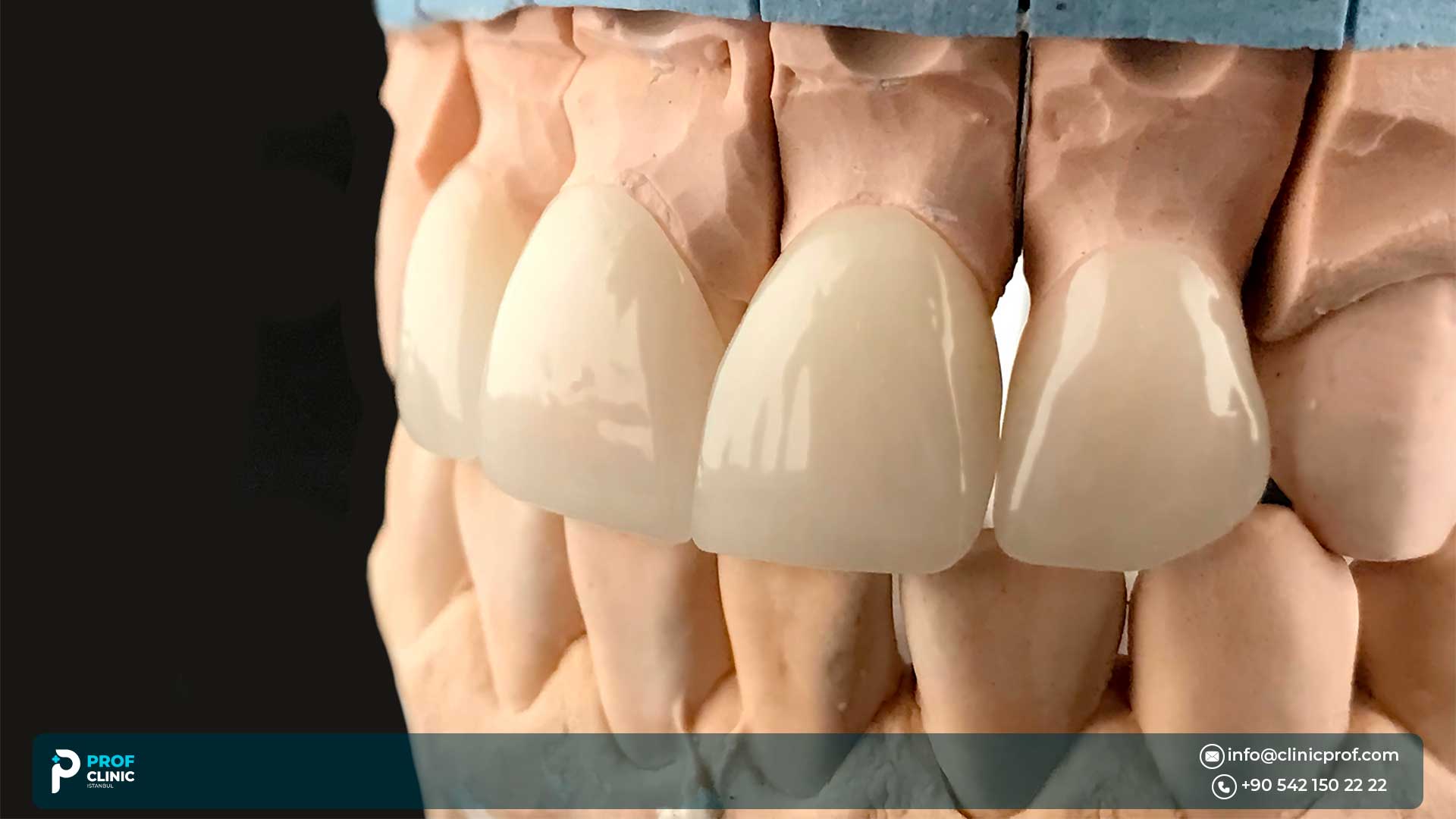 What Are Veneers?
