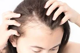 What Causes Hair Loss in Women?