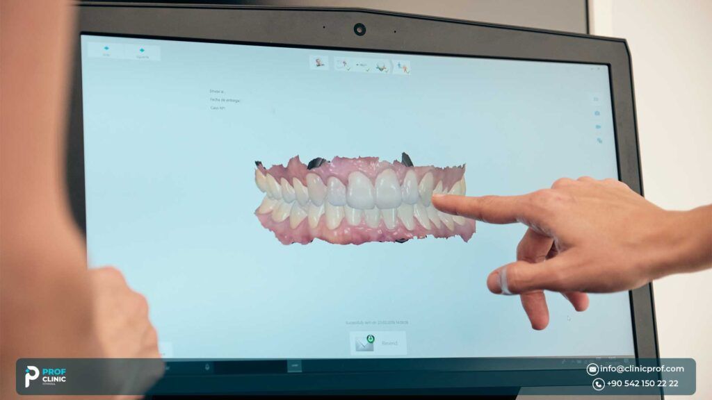 What Is a 3D Hollywood Smile?