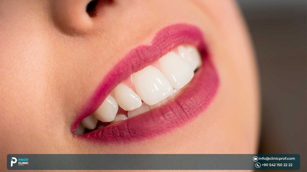 What Is a Dental Veneer?