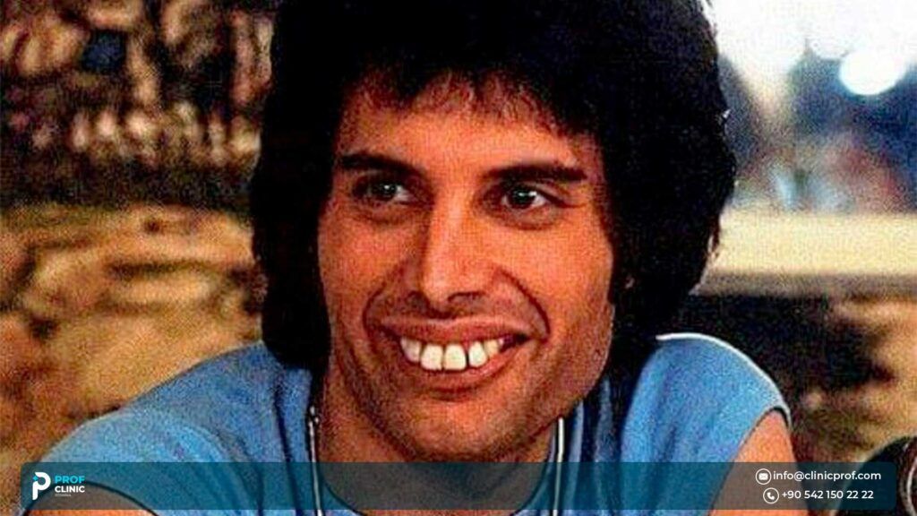 What Was Unique About Freddie Mercury’s Teeth?