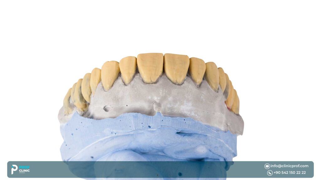 What are the types of zircon crown implementation steps in Turkey?