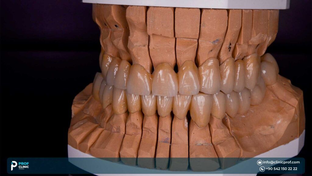 What are the types of zircon crowns? 