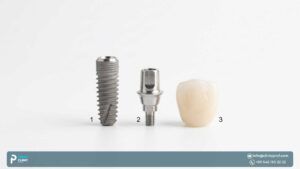 What do dental implants look like?
