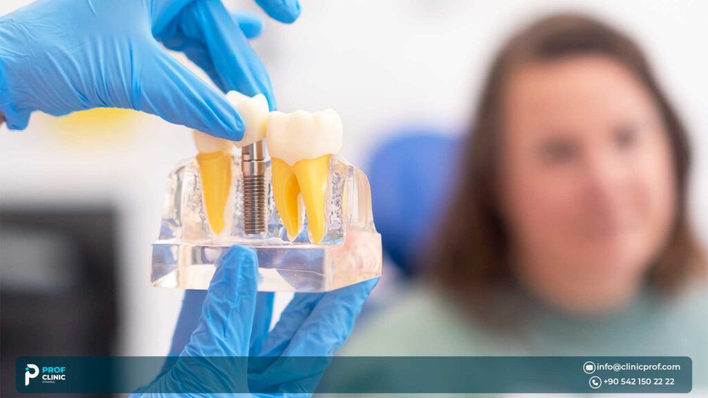 What do dental implants step by step include?