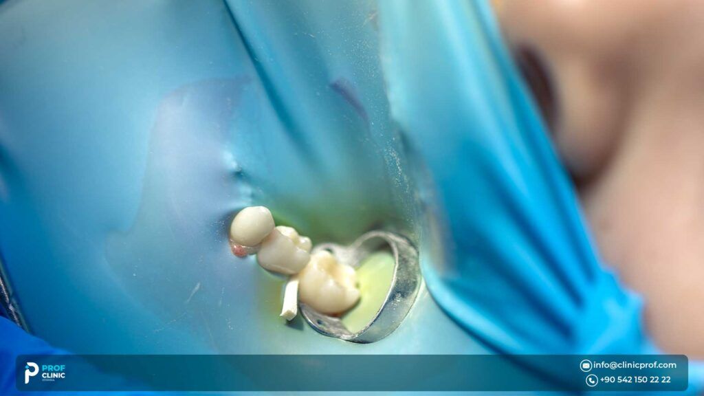 What is a Dental Crown and Why is Repair Needed?