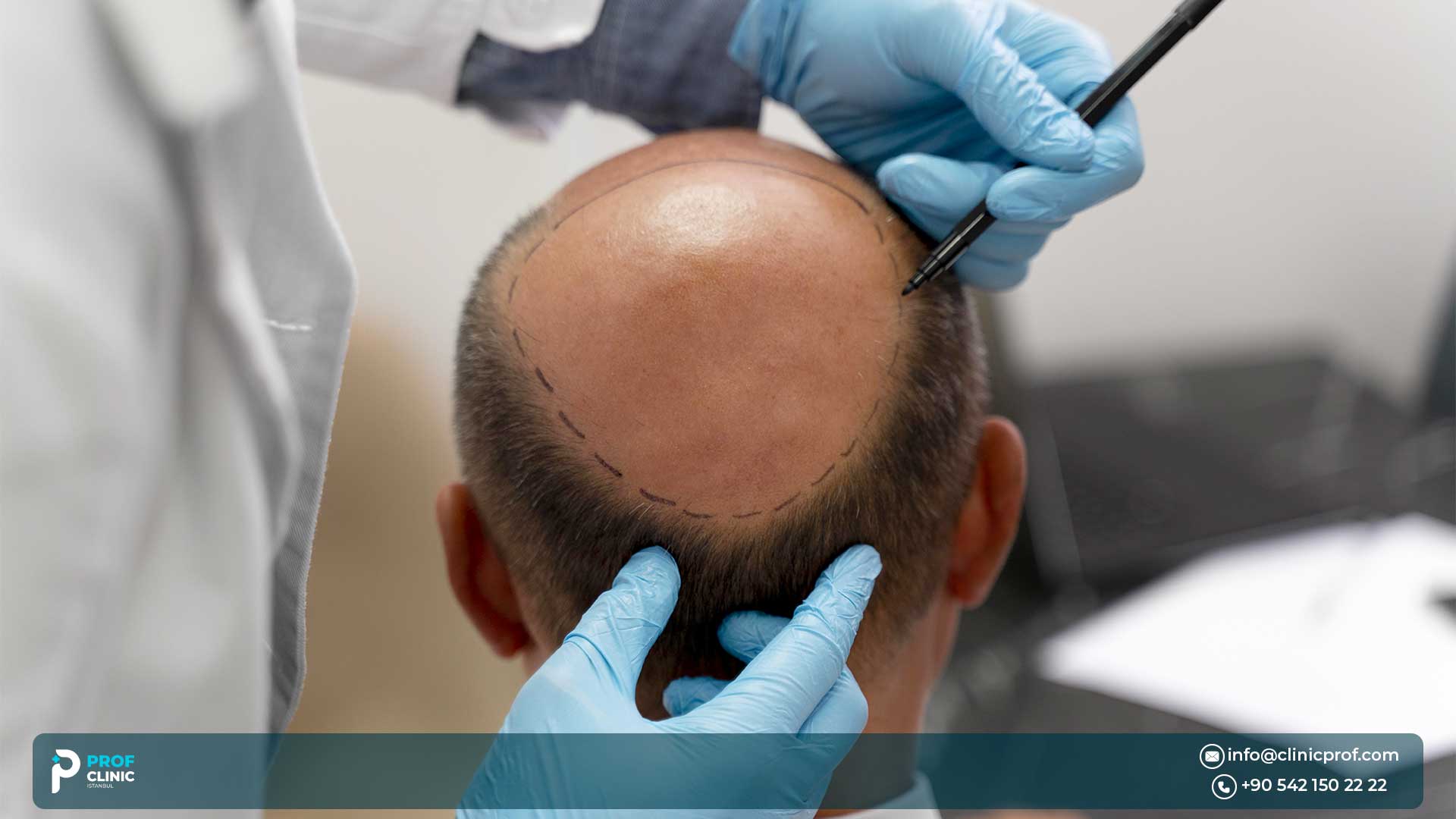 What is a FUE Hair Transplant?