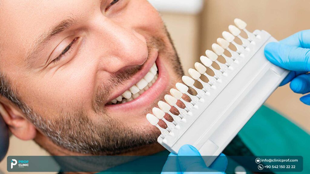 What is a Full Set of Veneers?