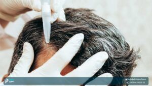What is hair transplantation?