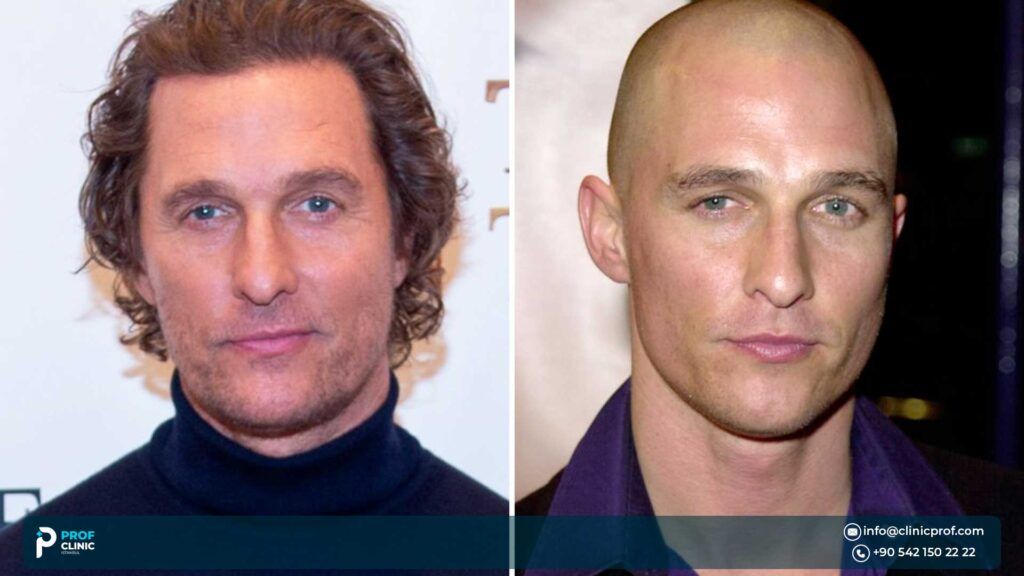When Did Matthew McConaughey Start Balding?