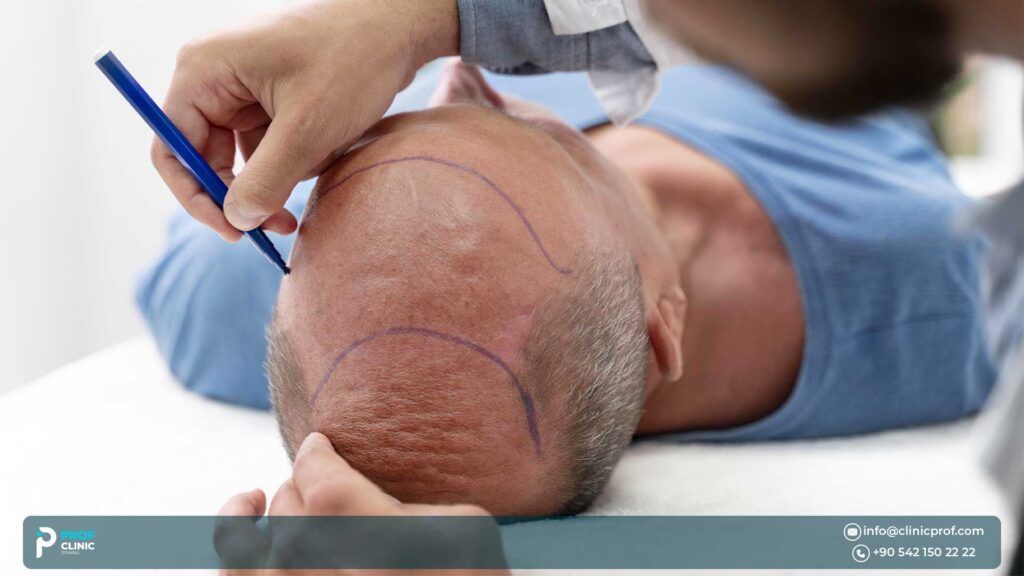 Who Needs a Hair transplant?