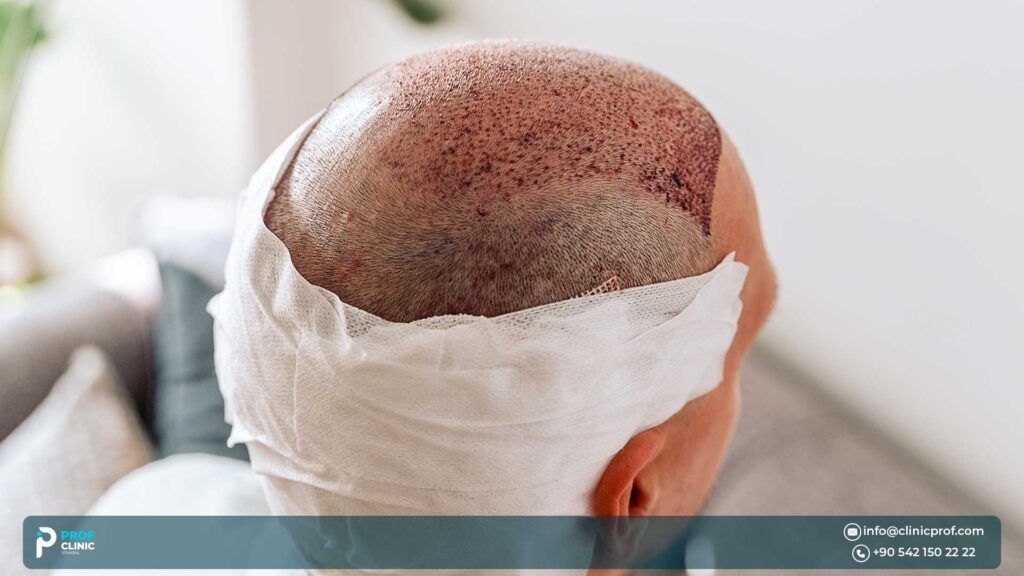 Why Is Hair Transplant Popular in Turkey?