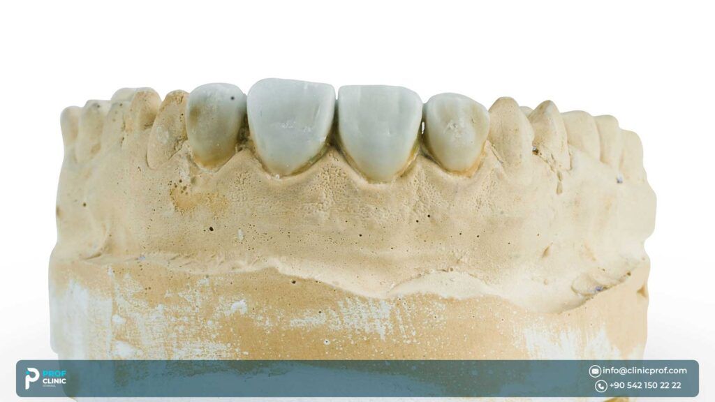 Why are Emax crowns the best for dental implants?