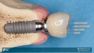 Why are Emax crowns the best for dental implants?