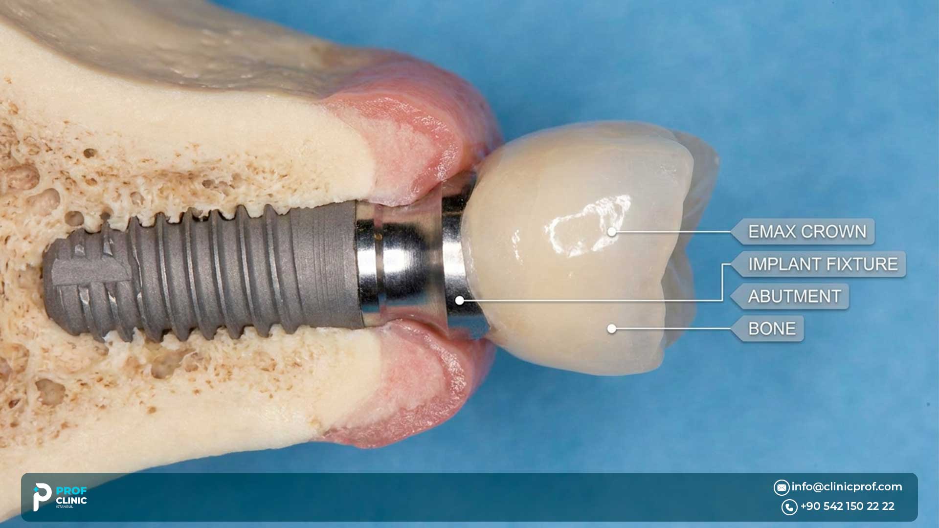 Why are Emax crowns the best for dental implants?