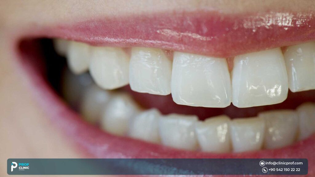 Yellow Teeth vs White Teeth
