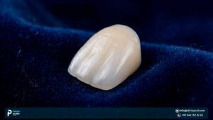 Zirconia Crowns: A Comprehensive Guide