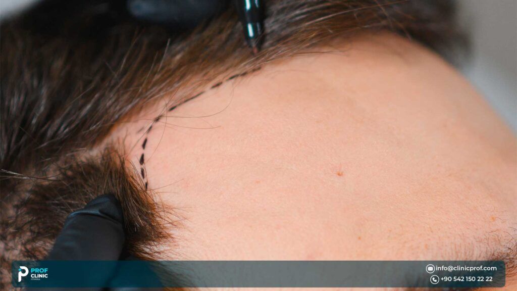 best hair transplantation in Istanbul Turkey - Prof Clinic Istanbul