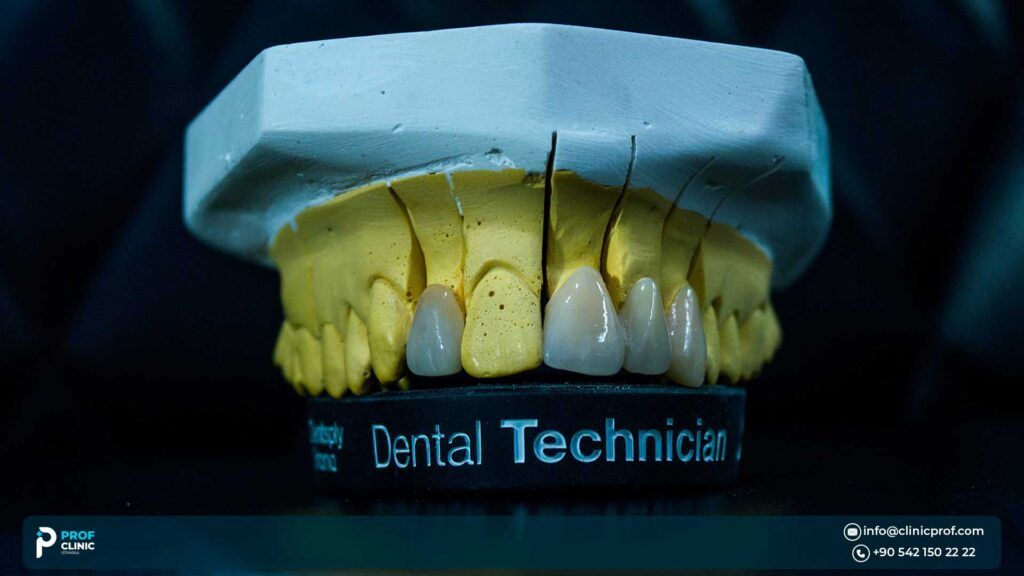 best types of veneers for teeth - veneers in Istanbul -prof clinic