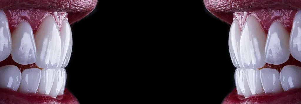 Feldspathic vs Emax Veneers