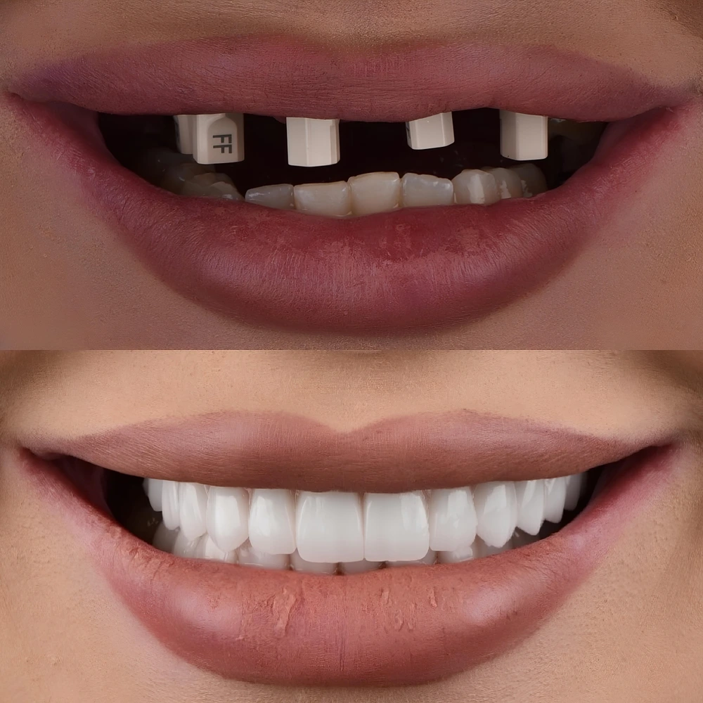 All on 4 dental implants before and after in Turkey
