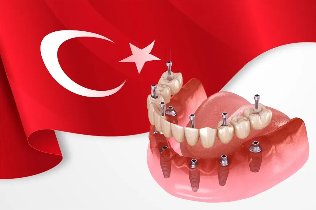 All on 6 dental implants cost in Turkey