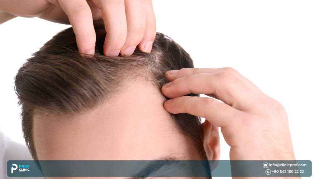 hair transplant in Istanbul reviews - Prof Clinic